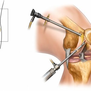 מתי באמת צריך ניתוח ארתרוסקופיה